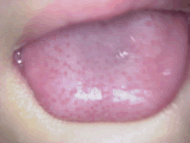 溶連菌以外 いちご舌 溶連菌と風邪の違いと注意点！原因や対処法についてもチェック！